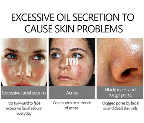Trattamento delicato 30g crema dell'acne di cura di pelle per la pelle sensibile incline dell'acne