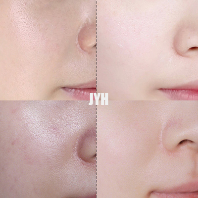 l'ultimo trattamento dell'acne della crema del punto 30g illumina e ripara la crema di fronte